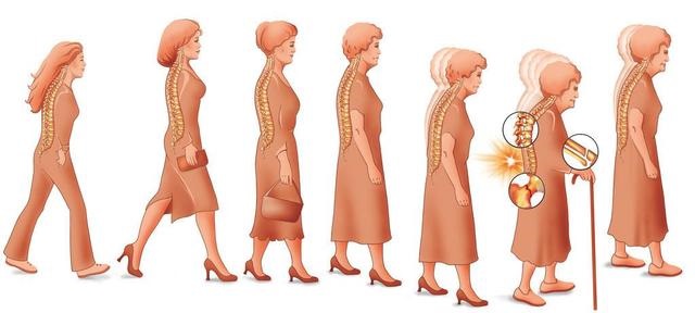 一分鐘測試題目評估你的骨質(zhì)疏松癥風險
