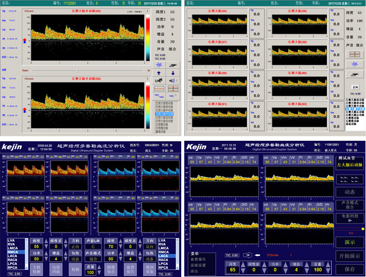 經(jīng)顱多普勒檢查和頸動脈彩超有什么區(qū)別